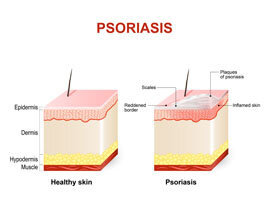 Effective measures Psorilax on any Irritation