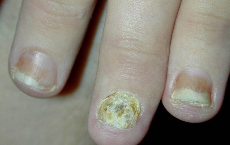 Psoriasis of the hand nails