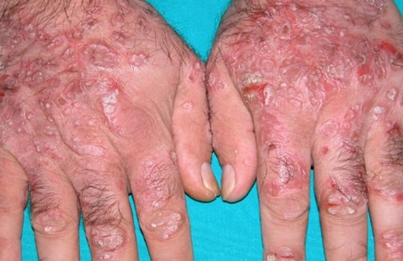 Tear psoriasis on the hands