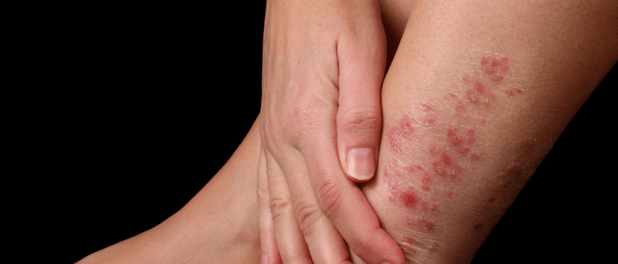 Psoriatic plaques on the skin of the leg