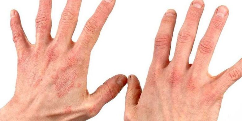 Psoriasis on the hands, how to treat folk remedies