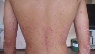 How to cure Psoriasis fast