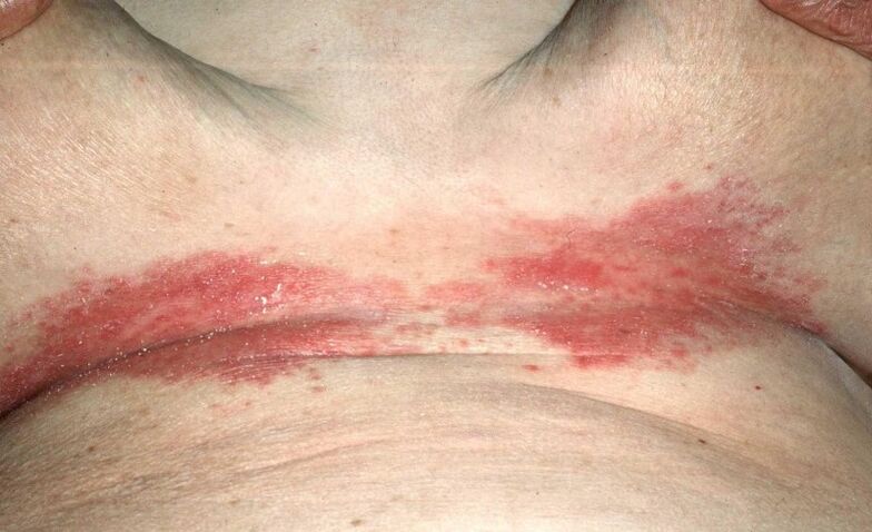 Psoriatic plaques under the chest