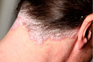 Psoriasis hairy part of the head