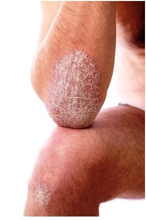 where there are psoriasis