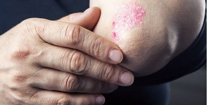 Symptoms of psoriasis on elbows