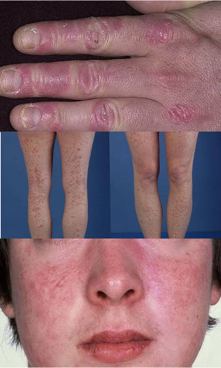 how does psoriasis on the hands feet and face