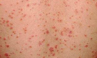 how does the beginning stage of psoriasis