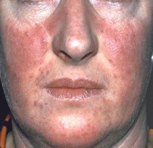 as the cure of Psoriasis on the face