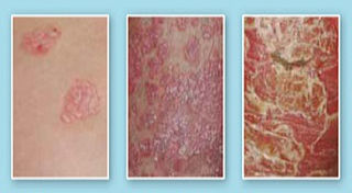 Stage of psoriasis