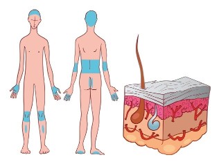 The most common places for the formation of psoriatic Plaques