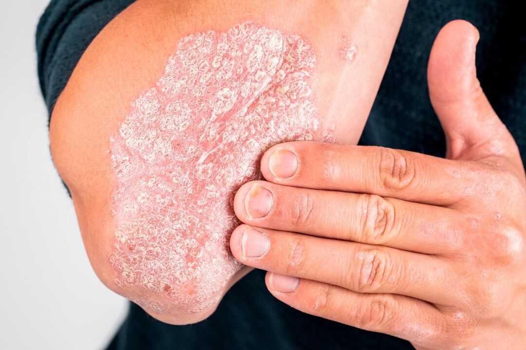 What does psoriasis look like on the skin