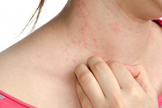 An exacerbation of psoriasis is manifested by skin rashes and severe itching