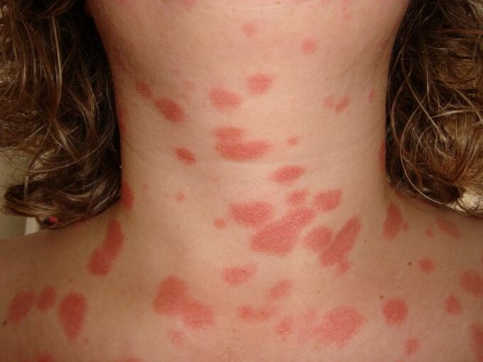 Psoriasis plaques on the skin