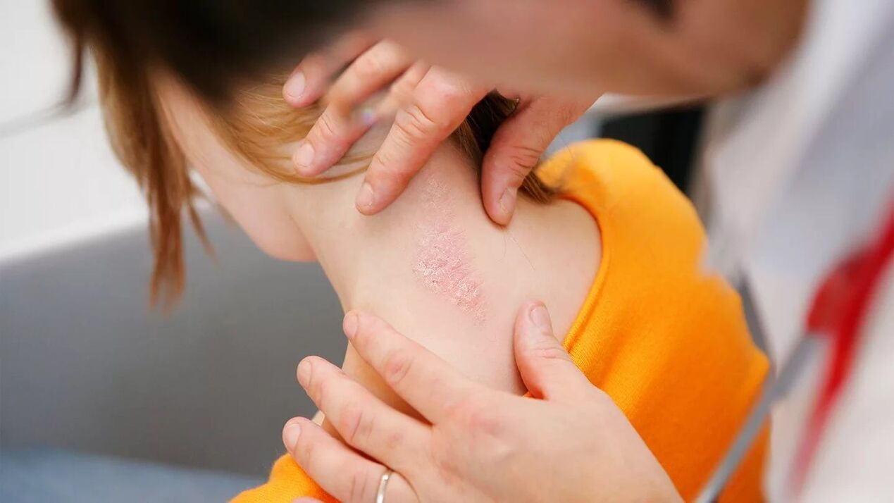 Methods for treating psoriasis