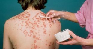 Method for the treatment of Psoriasis
