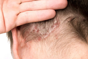 Worsening of psoriasis on the head