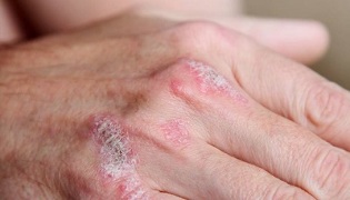 Symptoms of the initial stage of psoriasis