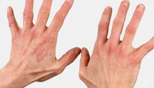 What does the initial stage of psoriasis look like