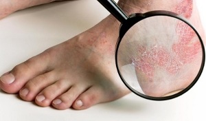Options for psoriasis therapy