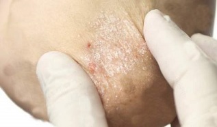 Treatment of psoriasis in the attenuating stage
