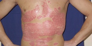 Instructions for the integrated treatment of Psoriasis