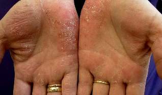 Medications for psoriasis
