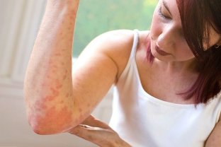 Psoriasis due to Stress from