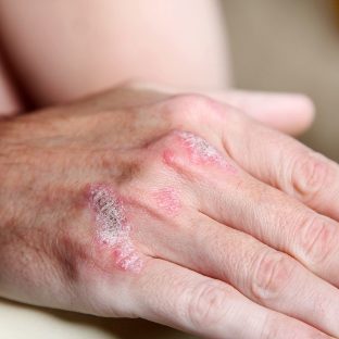 the Manifestation of Psoriasis