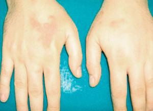 The localization of the disease on the Hand