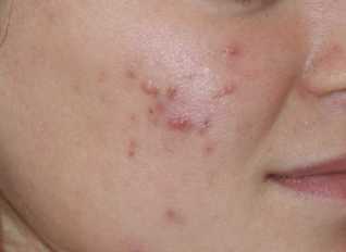 Psoriasis in the face