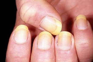 Psoriasis of the nails