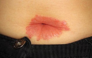A different psoriasis