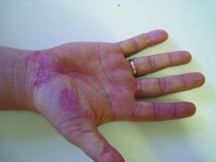 Pustulosis of palms and soles