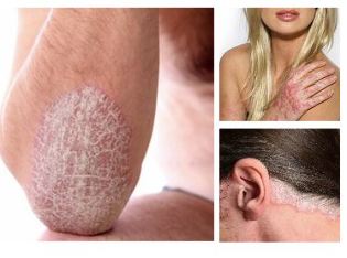 What is psoriasis and how to treat