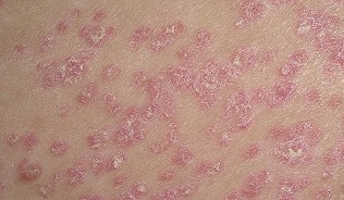 The beginning stage of psoriasis
