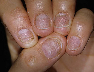 Psoriasis Nails